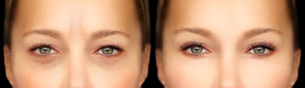 Restylane Lyft